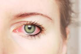 Comment calmer apaiser soulager traiter une conjonctivite à l'oeil avec des huiles essentielles naturelles bio ? Astuce et conseils pour calmer la douleur d'une conjonctivite à l'oeil.