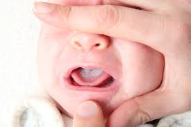 muguet du bébé comment traiter soigner naturellement sans médicament avec des huiles essentielles bio jpg